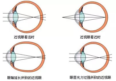 真正的，能根治高度近视眼的方法