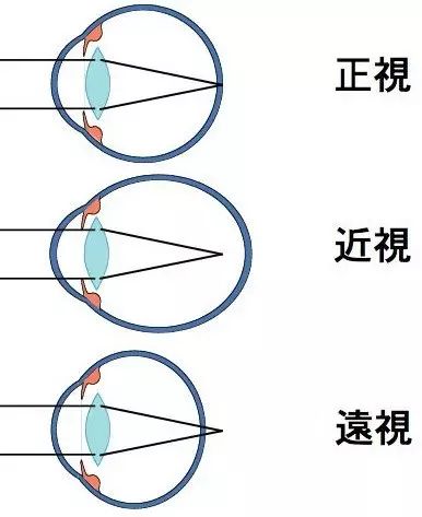 真正的，能根治高度近视眼的方法